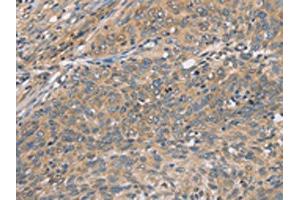 The image on the left is immunohistochemistry of paraffin-embedded Human cervical cancer tissue using ABIN7129065(CST2 Antibody) at dilution 1/50, on the right is treated with fusion protein. (CST2 抗体)