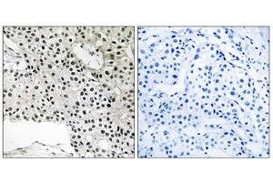 Immunohistochemistry analysis of paraffin-embedded human breast carcinoma tissue using TCEAL4 antibody. (TCEAL4 抗体  (C-Term))