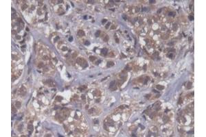 DAB staining on IHC-P; Samples: Human Breast cancer Tissue (UQCRB 抗体  (AA 2-111))