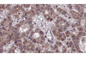 ABIN6273890 at 1/100 staining Human liver cancer tissue by IHC-P. (NPBWR1 抗体  (C-Term))