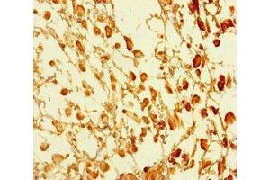 Immunohistochemistry of paraffin-embedded human melanoma using ABIN7172553 at dilution of 1:100 (GATA6 抗体  (AA 496-595))