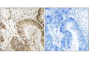 Immunohistochemistry analysis of paraffin-embedded human colon carcinoma tissue, using RGS1 Antibody. (RGS1 抗体  (AA 118-167))