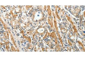 Immunohistochemistry of paraffin-embedded Human gastric cancer using E-Selectin Polyclonal Antibody at dilution of 1:40 (Selectin E/CD62e 抗体)
