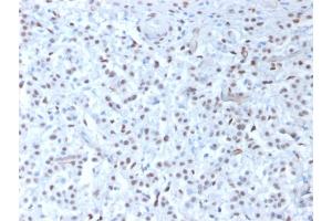 Formalin-fixed, paraffin-embedded human Mesothelioma stained with Wilm's Tumor Mouse Recombinant Monoclonal Antibody (rWT1/857). (Recombinant WT1 抗体)