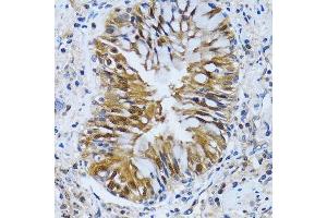 Immunohistochemistry of paraffin-embedded human lung cancer using IMPA1 antibody. (IMPA1 抗体  (AA 1-277))
