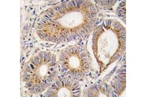 IHC analysis of FFPE human colon carcinoma tissue stained with FGF1 antibody (FGF1 抗体  (AA 5-30))