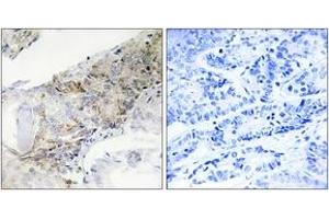 Immunohistochemistry analysis of paraffin-embedded human breast carcinoma tissue, using COX5B Antibody. (COX5B 抗体  (AA 11-60))