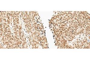Immunohistochemistry of paraffin-embedded Human ovarian cancer tissue using FUT3 Polyclonal Antibody at dilution of 1:35(x200) (FUT3 抗体)