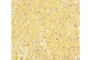 Immunohistochemistry of paraffin-embedded human glioma using ABIN7146992 at dilution of 1:100 (CTNND2 抗体  (AA 4-308))
