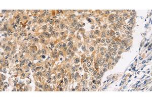Immunohistochemistry of paraffin-embedded Human lung cancer using JNK2 Polyclonal Antibody at dilution of 1:30 (JNK2 抗体)