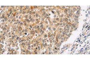 Immunohistochemistry of paraffin-embedded Human lung cancer using JNK2 Polyclonal Antibody at dilution of 1:30 (JNK2 抗体)
