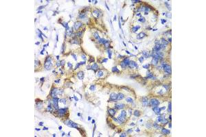 Immunohistochemistry of paraffin-embedded human liver cancer using RPL9 antibody. (RPL9 抗体)