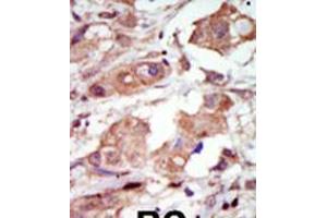 Formalin-fixed and paraffin-embedded human cancer tissue reacted with the primary antibody, which was peroxidase-conjugated to the secondary antibody, followed by DAB staining. (MAP3K10 抗体  (C-Term))