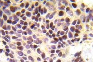 Immunohistochemistry (IHC) analyzes of BRCA1 pAb in paraffin-embedded human breast carcinoma tissue. (BRCA1 抗体)