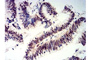 Immunohistochemical analysis of paraffin-embedded colon cancer tissues using CIRBP mouse mAb with DAB staining. (CIRBP 抗体  (AA 1-90))