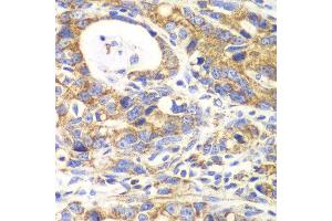 Immunohistochemistry of paraffin-embedded human gastric cancer using GLUD2 antibody at dilution of 1:100 (x40 lens). (GLUD2 抗体)