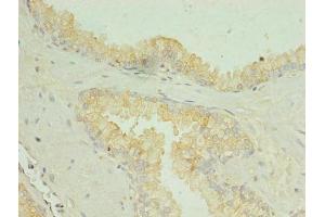 Immunohistochemistry of paraffin-embedded human prostate cancer using ABIN7169990 at dilution of 1:100 (SLC34A2 抗体  (AA 574-689))