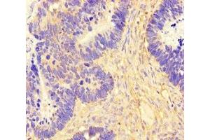 Immunohistochemistry of paraffin-embedded human ovarian cancer using ABIN7165554 at dilution of 1:100 (FAM71F2 抗体  (AA 1-300))