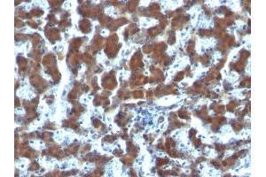 Formalin-fixed, paraffin-embedded human Hepatocellular Carcinoma stained with RBP1 Mouse Monoclonal Antibody (G4E4). (RBP4 抗体)