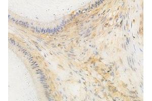 ABIN6259959 and ABIN6266647 at 1/100 staining human testicular cancer by IHC-P. (SAE1 抗体  (Internal Region))