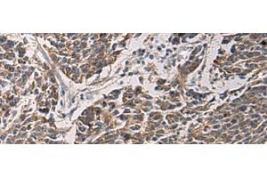 Immunohistochemistry of paraffin-embedded Human colorectal cancer tissue using MAPKAPK3 Polyclonal Antibody at dilution of 1:95(x200) (MAPKAP Kinase 3 抗体)