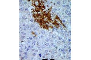 Formalin-fixed and paraffin-embedded human cancer tissue reacted with the primary antibody, which was peroxidase-conjugated to the secondary antibody, followed by AEC staining. (PNCK 抗体  (C-Term))