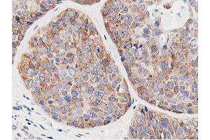 Immunohistochemical staining of paraffin-embedded Adenocarcinoma of Human breast tissue using anti-LCMT1 mouse monoclonal antibody. (LCMT1 抗体)