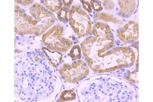 Paraformaldehyde-fixed, paraffin embedded Human breast carcinoma, Antigen retrieval by boiling in sodium citrate buffer (pH6) for 15min, Block endogenous peroxidase by 3% hydrogen peroxide for 30 minutes, Blocking buffer at 37°C for 20min, Antibody incubation with Cytokeratin 18 (1F11) Monoclonal Antibody  at 1:50 overnight at 4°C, followed by a conjugated secondary and DAB staining. (Cytokeratin 18 抗体)