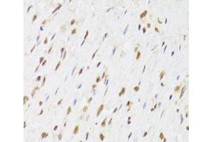 Immunohistochemistry of paraffin-embedded Human gastric cancer using RUVBL1 Polyclonal Antibody at dilution of 1:100 (40x lens). (RUVBL1 抗体)