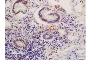 Formalin-fixed and paraffin embedded human colon carcinoma labeled with Anti-Phospho-MDM2(Ser186) Polyclonal Antibody, Unconjugated (ABIN802548) at 1:200 followed by conjugation to the secondary antibody and DAB staining
