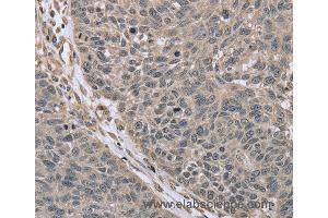 Immunohistochemistry of Human lung cancer using RHEB Polyclonal Antibody at dilution of 1:40