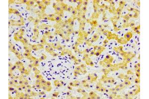 IHC image of ABIN7152767 diluted at 1:300 and staining in paraffin-embedded human liver cancer performed on a Leica BondTM system. (FGL1 抗体  (AA 179-282))
