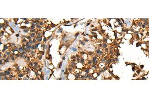Immunohistochemistry of paraffin-embedded Human ovarian cancer tissue using SHPK Polyclonal Antibody at dilution of 1:45(x200) (SHPK 抗体)