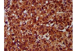 IHC image of ABIN7151929 diluted at 1:400 and staining in paraffin-embedded human glioma performed on a Leica BondTM system. (EMP2 抗体  (AA 22-66))