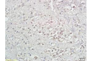 Formalin-fixed and paraffin embedded human hepatoma labeled with Anti-LAMP-3/DC-LAMP/CD208 Polyclonal Antibody, Unconjugated (ABIN742005) at 1:300 followed by conjugation to the secondary antibody and DAB (LAMP3 抗体  (AA 301-416))
