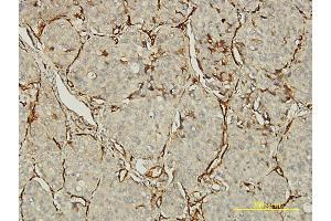 Immunoperoxidase of monoclonal antibody to PECAM1 on formalin-fixed paraffin-embedded human lung, adenosquamous cell carcinoma tissue. (CD31 抗体  (AA 29-738))