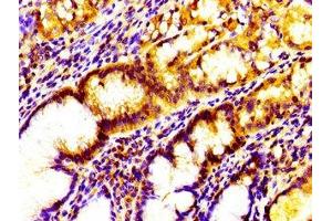 Immunohistochemistry of paraffin-embedded human gastric cancer using ABIN7156813 at dilution of 1:100 (IL17D 抗体  (AA 16-202))