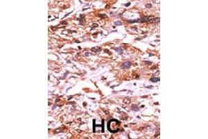 Formalin-fixed and paraffin-embedded human hepatocellular carcinoma tissue reacted with CDC25A (phospho S124) polyclonal antibody  which was peroxidase-conjugated to the secondary antibody followed by AEC staining. (CDC25A 抗体  (pSer124))