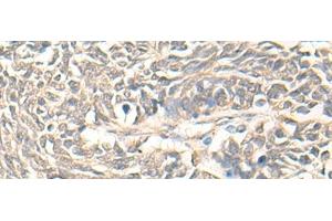 Immunohistochemistry of paraffin-embedded Human lung cancer tissue using DMC1 Polyclonal Antibody at dilution of 1:30(x200) (DMC1 抗体)