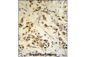 RBM3 Antibody (Center) (R) IHC analysis in formalin fixed and paraffin embedded human breast carcinoma followed by peroxidase conjugation of the secondary antibody and DAB staining.
