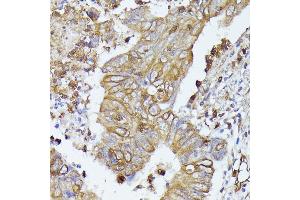 Immunohistochemistry of paraffin-embedded human colon carcinoma using CD52 antibody (ABIN7266207) at dilution of 1:100 (40x lens). (CD52 抗体  (AA 1-61))