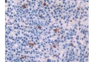 Detection of PF4 in Human Skin cancer Tissue using Polyclonal Antibody to Platelet Factor 4 (PF4) (PF4 抗体  (AA 31-101))