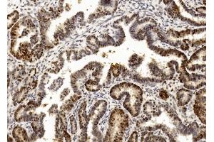 Immunohistochemical analysis of paraffin-embedded Human Ovarian cancer section using Pink1 (ABIN1882273 and ABIN2838445). (PCNA 抗体  (C-Term))
