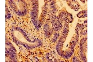 Immunohistochemistry of paraffin-embedded human colon cancer using ABIN7144021 at dilution of 1:100 (AMPD2 抗体  (AA 1-129))