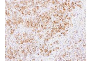 IHC-P Image Immunohistochemical analysis of paraffin-embedded SCM1 xenograft, using PABPC3, antibody at 1:100 dilution. (PABPC3 抗体)