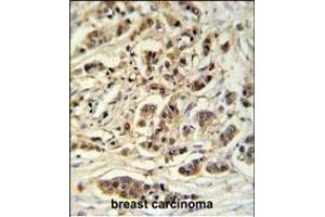 M11D1 Antibody (N-term) (ABIN653932 and ABIN2843164) IHC analysis in formalin fixed and paraffin embedded breast carcinoma followed by peroxidase conjugation of the secondary antibody and DAB staining.