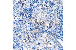 Immunohistochemistry of paraffin-embedded human cervix cancer using IL22 Rabbit pAb (ABIN6128134, ABIN6142363, ABIN6142364 and ABIN6221808) at dilution of 1:1000 (40x lens). (IL-22 抗体  (AA 34-179))