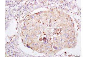 Formalin-fixed and paraffin embedded human lung carcinoma labeled with Anti-LRRC25 Polyclonal Antibody, Unconjugated  at 1:200 followed by conjugation to the secondary antibody and DAB staining (LRRC25 抗体  (AA 81-180))