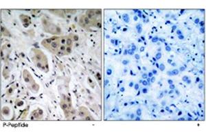 Immunohistochemical analysis of paraffin-embedded human breast carcinoma tissue using AKT1 (phospho S473) polyclonal antibody . (AKT1 抗体  (pSer473))