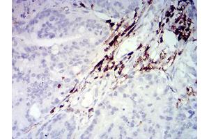 Immunohistochemical analysis of paraffin-embedded rectum cancer tissues using CD45 mouse mAb with DAB staining. (CD45 抗体  (AA 431-577))
